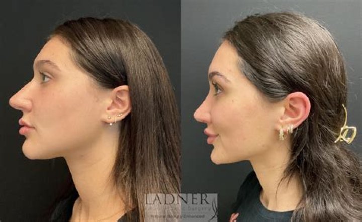 Hannah Brown Nose Job: Did She Get A Plastic Surgery?