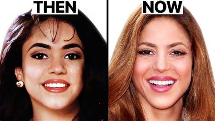 Shakira Botox And Lip Surgery – Before And After Photos
